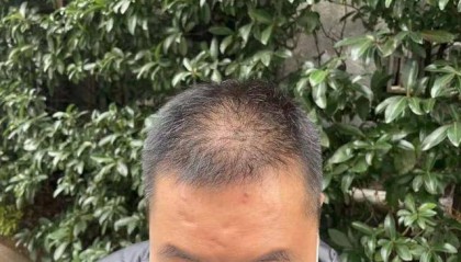 “还能反光！”长沙男子植发近9月称后脑勺“像狗啃过”