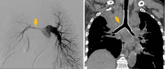 潍坊市第二人民医院完成首例气管支架、肺动脉覆膜支架同期植入术